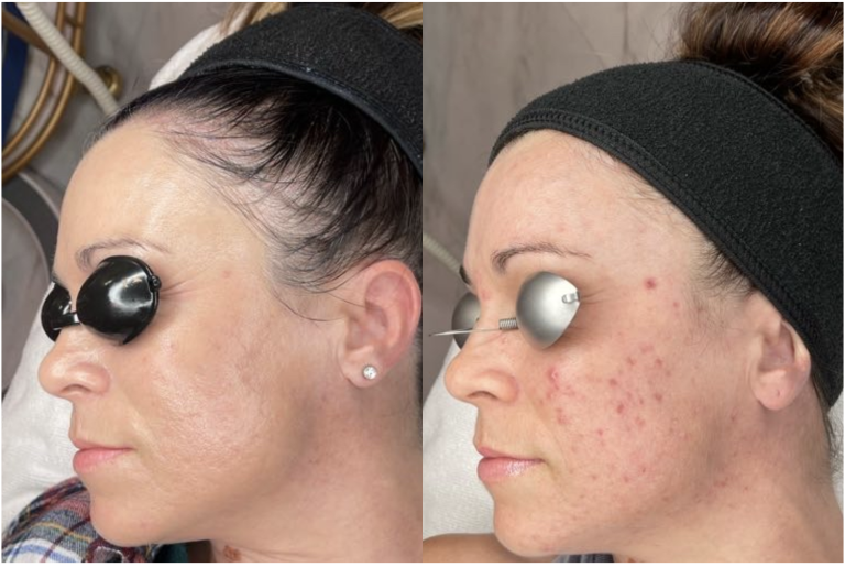 In the realm of advanced skincare, Genius Microneedling Paradise Valley has become a revolutionary treatment for individuals looking to reduce wrinkles, minimize scars, and rejuvenate their skin. At Skin With Bea, this state-of-the-art procedure combines precision technology with personalized care, delivering outstanding results for smoother, younger-looking skin. Microneedling has long been celebrated for stimulating collagen production, which is crucial for skin elasticity and minimizing fine lines. However, the Genius Microneedling Phoenix system elevates traditional microneedling by integrating radio-frequency energy. This dual-action technology penetrates deeper layers of the skin, enhancing natural healing processes and promoting the growth of collagen and elastin. The result is a visible reduction in wrinkles and improved skin texture, making it ideal for anyone seeking non-surgical anti-aging solutions. What Makes Genius Microneedling Scottsdale Unique? Genius Microneedling Scottsdale is highly customizable, allowing practitioners to adjust needle depth and intensity according to each patient’s specific skin needs. Whether the goal is to smooth fine lines, reduce deep wrinkles, or diminish acne scars, this treatment can be tailored for maximum results. The minimally invasive procedure ensures that recovery time is short, and most patients can resume daily activities shortly after their session. Another advantage is the treatment’s compatibility with nutrient-rich serums and topical products. After microneedling, the skin absorbs these products more effectively, enhancing hydration and overall skin health. At Skin With Bea, every session is designed to combine advanced technology with professional care, ensuring safety, comfort, and optimal results. Reducing Acne Scars with Genius Microneedling Paradise Valley Acne scars can be a persistent challenge for many individuals, often remaining long after active acne has cleared. Traditional skincare methods often fail to address these deeper scars. Genius Microneedling Paradise Valley penetrates below the skin’s surface, stimulating tissue regeneration and smoothing uneven textures. With a series of treatments, patients notice a reduction in scar depth, improved skin texture, and a more radiant complexion. Patients in Phoenix and surrounding areas have reported impressive improvements after treatments. By targeting both the superficial and deeper layers of the skin, Genius Microneedling Phoenix offers a comprehensive solution for lasting skin rejuvenation. Anti-Aging Benefits of Genius Microneedling Scottsdale Wrinkles and fine lines are natural signs of aging, caused by a gradual decline in collagen and elastin. Genius Microneedling Scottsdale works by stimulating the skin’s natural repair mechanisms, restoring firmness, and promoting elasticity. Over time, patients experience smoother skin, reduced visible wrinkles, and a more youthful overall appearance. Unlike invasive procedures, Genius Microneedling provides noticeable results without surgery or extensive downtime. This makes it an ideal choice for busy individuals seeking effective anti-aging treatments in a safe and controlled environment. Why Choose Skin With Bea for Genius Microneedling Paradise Valley? At Skin With Bea, patient care and results are the top priorities. The clinic’s team of skilled professionals ensures that each session of Genius Microneedling Paradise Valley is tailored to individual needs, addressing specific concerns such as wrinkles, scars, or uneven skin texture. With a combination of advanced technology, expert guidance, and post-treatment support, patients achieve long-lasting improvements and healthier, revitalized skin. Whether you are looking to reduce signs of aging, smooth acne scars, or simply improve skin texture, Genius Microneedling provides a versatile solution for all skin types. Residents of Paradise Valley, Scottsdale, and Phoenix can benefit from this innovative treatment to achieve glowing, rejuvenated skin. Conclusion Genius Microneedling Paradise Valley is a powerful, non-surgical solution for anyone seeking to minimize wrinkles, reduce scars, and enhance overall skin appearance. By stimulating collagen and elastin production and improving the skin’s natural repair process, this treatment delivers noticeable results with minimal downtime. With the professional expertise of Skin With Bea, patients in Phoenix, Scottsdale, and Paradise Valley can experience customized treatments that address their unique skin concerns. For those seeking smoother, youthful skin, Genius Microneedling offers a safe, effective, and advanced solution.