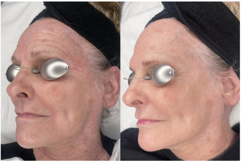 Genius RF Microneedling