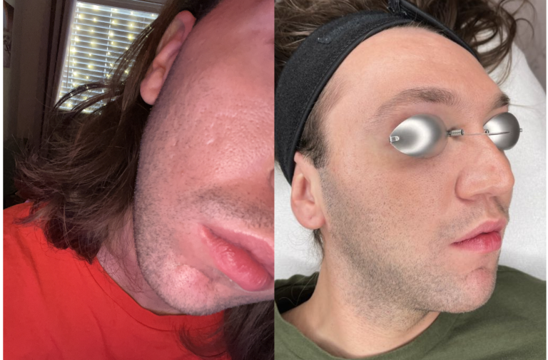 Noah’s Acne Scar