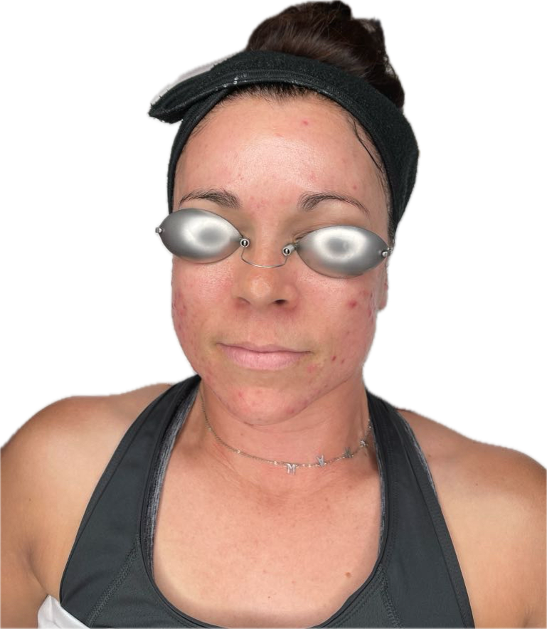 Aging, sun damage, and environmental stressors can leave your skin looking tired, uneven, and less radiant. For residents of Arizona, cutting-edge cosmetic treatments like radiofrequency microneedling Phoenix offer an effective way to revitalize the skin, reduce fine lines, and restore a youthful glow. At Skin With Bea, we specialize in advanced skin treatments that combine innovation with safety to help you achieve smooth, glowing, and healthy skin. What Is Radiofrequency Microneedling? Radiofrequency microneedling is a minimally invasive procedure that uses fine needles to create micro-injuries in the skin while simultaneously delivering radiofrequency energy into the deeper layers. This stimulates your body’s natural collagen and elastin production, essential for maintaining firm and elastic skin. Compared to traditional microneedling, the addition of radiofrequency allows for deeper penetration and more significant skin tightening results without extensive downtime. Benefits of Radiofrequency Microneedling Phoenix Residents seeking radiofrequency microneedling Phoenix can enjoy multiple benefits: Reduction of fine lines and wrinkles Improved skin texture and elasticity Diminished acne scars and hyperpigmentation Minimally invasive procedure with minimal downtime The treatment works for all skin types and tones, making it a versatile solution for anyone looking for noticeable skin improvements without surgery. Why Choose Radiofrequency Microneedling Scottsdale? For those living in Scottsdale, radiofrequency microneedling Scottsdale is ideal for targeting stubborn skin concerns such as wrinkles, enlarged pores, and uneven texture. This procedure encourages natural collagen production, ensuring progressive improvement over time. Many Scottsdale clients choose this treatment for its ability to provide significant results while remaining gentle on the skin. Transform Your Skin with Radiofrequency Microneedling Paradise Valley Clients in Paradise Valley can benefit from radiofrequency microneedling Paradise Valley to reduce scars, sun damage, and other skin imperfections. The treatment promotes skin regeneration at both superficial and deep levels, resulting in smoother, healthier, and more vibrant skin. Combining this with other treatments like PRP therapy or topical serums can further enhance results for a complete skin rejuvenation experience. What to Expect During the Procedure Safety and comfort are top priorities at Skin With Bea. Each session is customized to the client’s skin needs, with minimal discomfort. Most clients experience a mild sensation similar to a sunburn for a day or two. Over the following weeks, collagen remodeling leads to firmer, smoother, and more youthful skin. Why Skin With Bea Is the Right Choice Choosing the right provider ensures optimal results. Skin With Bea has extensive experience performing radiofrequency microneedling in Phoenix, Scottsdale, and Paradise Valley. Our personalized approach addresses unique skin concerns and delivers natural, beautiful outcomes. Whether you want to improve under-eye areas, reduce stretch marks, or enhance overall skin texture, our team creates a treatment plan tailored to you. Long-Term Results and Maintenance One of the major advantages of radiofrequency microneedling Phoenix is its progressive and long-lasting results. Collagen production continues for months after treatment, improving skin firmness, texture, and tone over time. Regular sessions help maintain these effects, ensuring that your skin remains rejuvenated and healthy. Conclusion Radiofrequency microneedling is a revolutionary way to rejuvenate your skin, offering noticeable improvements in texture, firmness, and overall radiance without invasive surgery. Whether you choose radiofrequency microneedling Phoenix, radiofrequency microneedling Scottsdale, or radiofrequency microneedling Paradise Valley, this treatment stimulates collagen production, reduces fine lines, and helps restore youthful, glowing skin. At Skin With Bea, we combine advanced technology with personalized care to ensure safe, effective, and long-lasting results. Take the first step toward healthier, more vibrant skin today and experience the transformative benefits of radiofrequency microneedling.