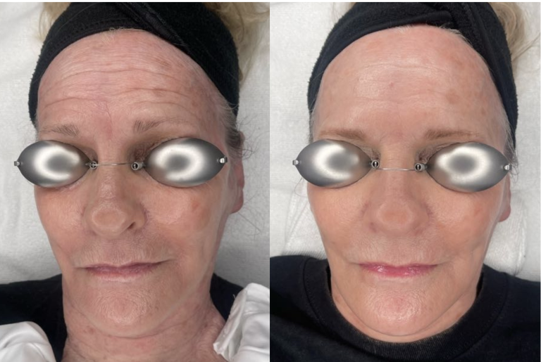 Bonnie’s Wrinkle Treatment