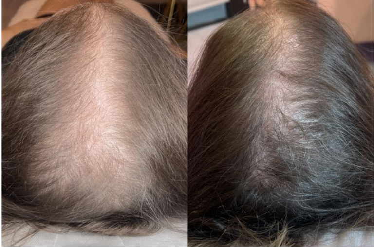 Crystal’s Hair Growth Treatment