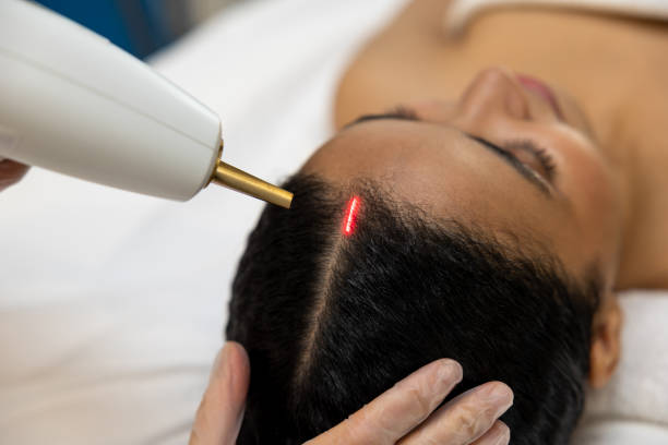 Benefits of Laser Hair Restoration Phoenix for Thinning Hair