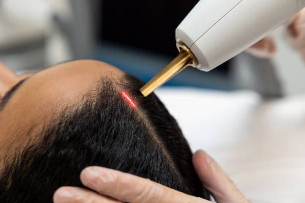 laser hair restoration