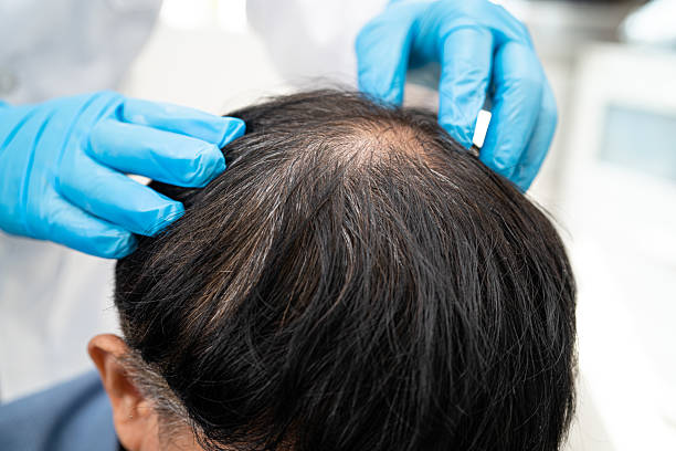 keralase hair loss treatment Phoenix