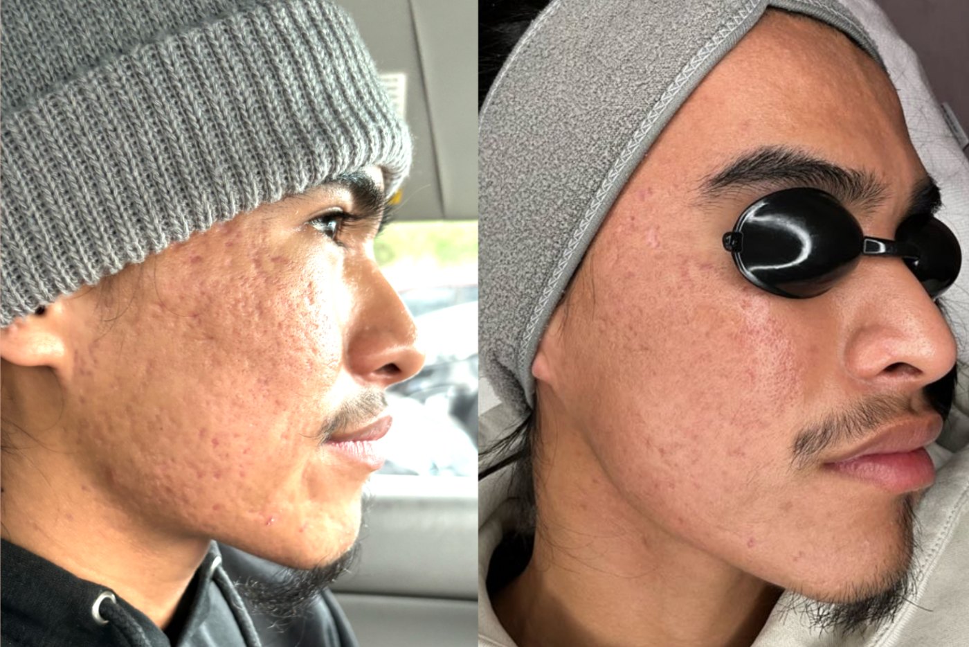 Acne scar before and after, right side of the face, after the TotalSkin Solution at Skin With Bea Esthetics, Scottsdale
