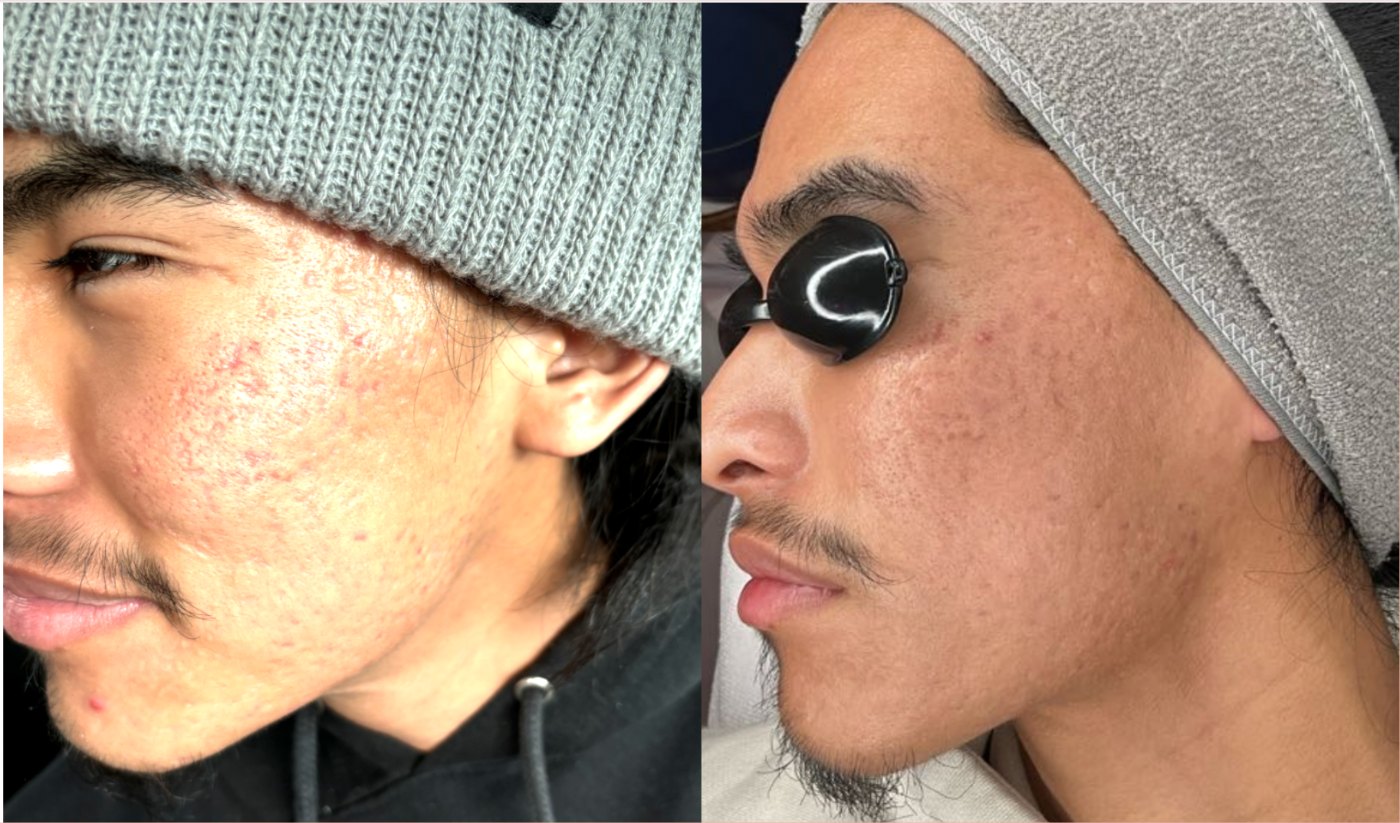 Acne scar before and after, left side of the face, after the TotalSkin Solution at Skin With Bea Esthetics, Scottsdale