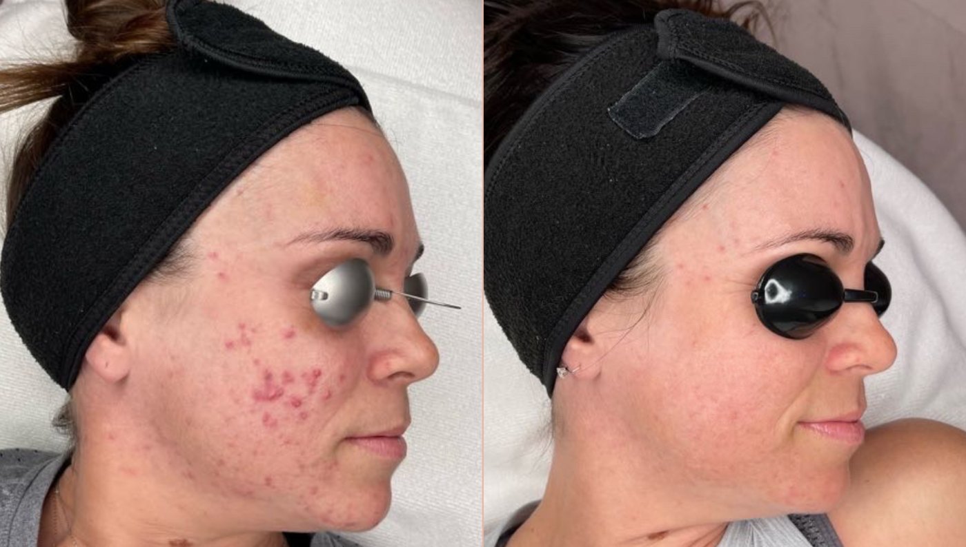 Adult acne before and after on the cheek after an acne treatment program at Skin With Bea Esthetics, Scottsdale