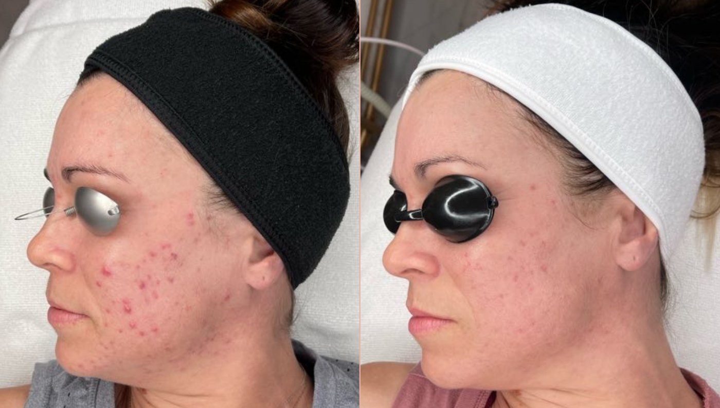 Adult acne before and after, right cheek, after an acne treatment program at Skin With Bea Esthetics, Scottsdale