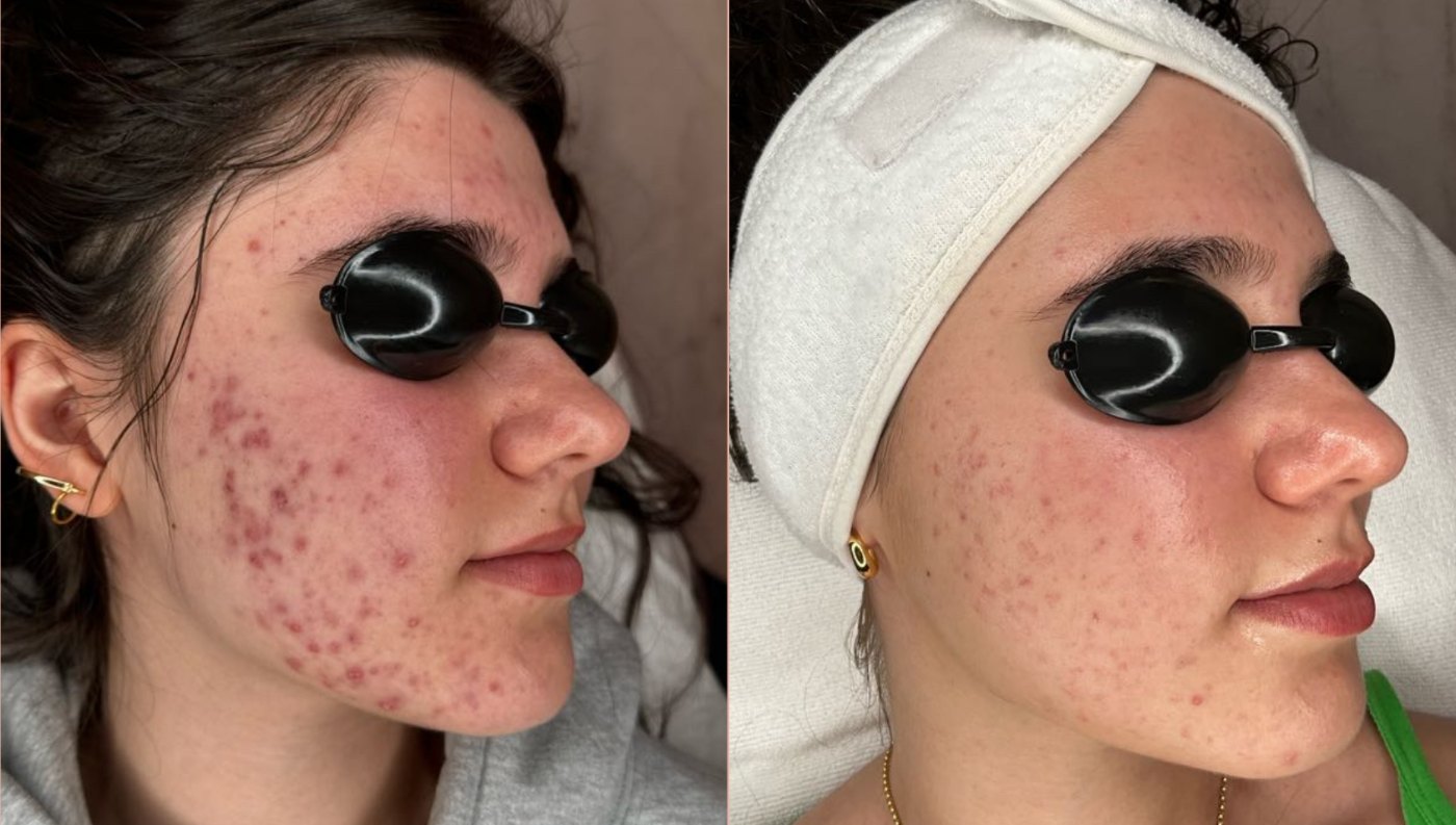 Inflamed hormonal acne on the jawline and cheek before and after an acne treatment program at Skin With Bea Esthetics, Scottsdale