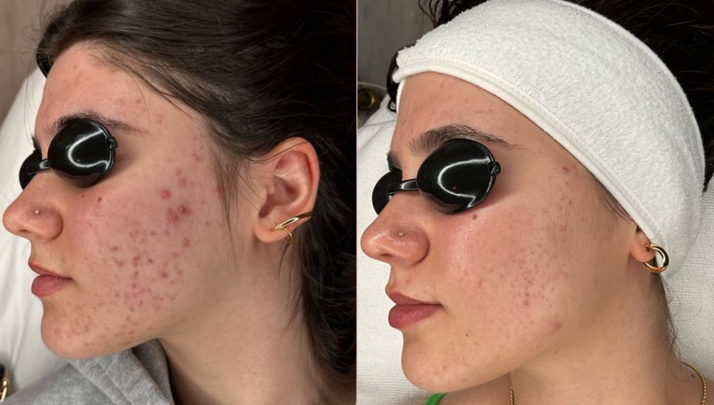 Hormonal acne before and after, left side of the face, after an acne treatment program at Skin With Bea Esthetics, Scottsdale