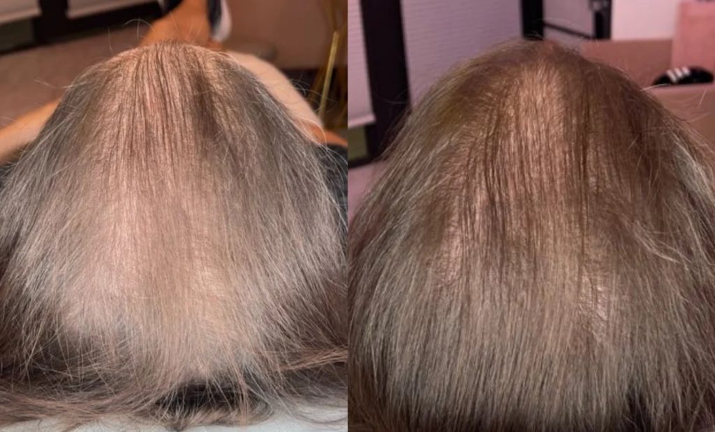 KeraLase before and after at Skin With Bea in Scottsdale: the top of a woman's head with thinning gray-blonde hair (left) and fuller coverage after a KeraLase series (right)