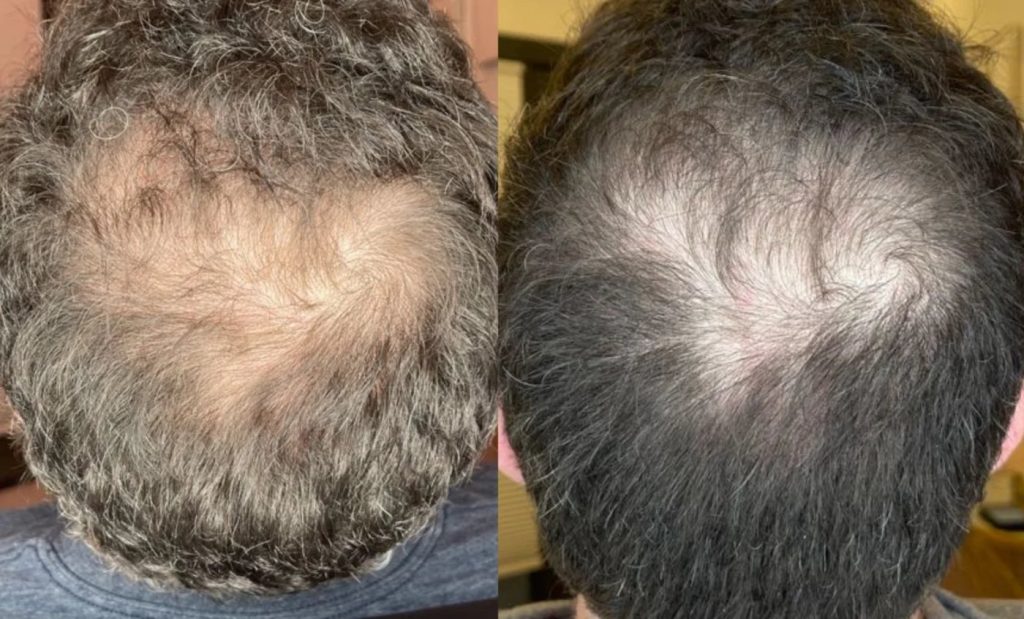 KeraLase before and after: the crown of a man with dark curly hair, with more scalp showing before (left) and less after a KeraLase series (right)