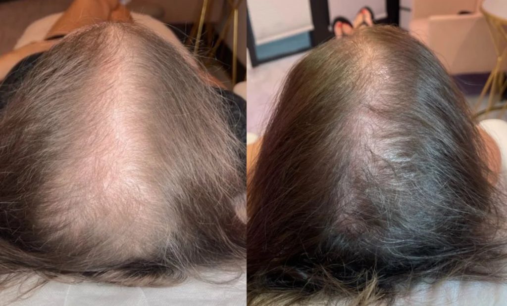 KeraLase before and after: a woman's center part, wide and see-through before (left) and narrower and fuller after a KeraLase series (right)