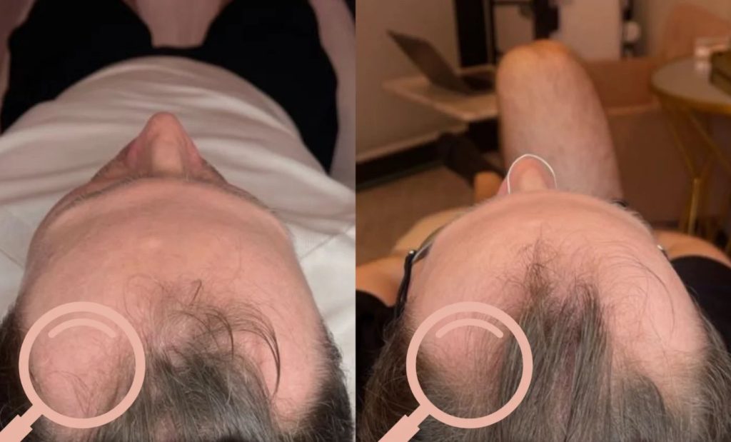 KeraLase before and after: a man's temples and frontal hairline seen from above, before (left) and after a KeraLase series (right), with the treated temple areas circled