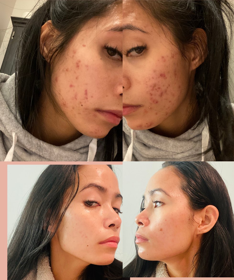 Nurse Bea’s own acne before and after: severe adult acne at 30, and her skin after treating every stage of it at once