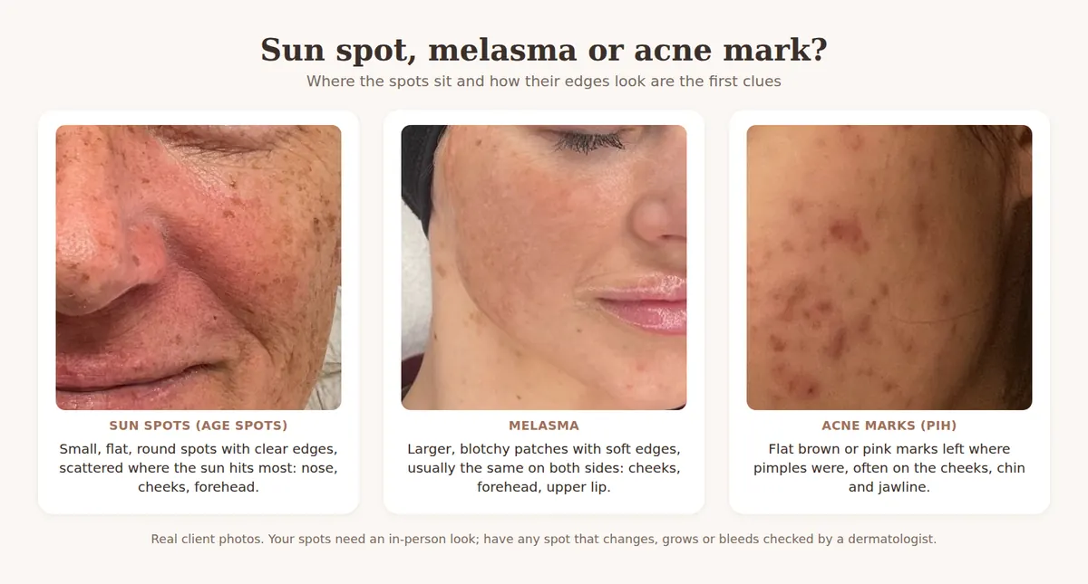 Close-up photos comparing sun spots on the nose and cheek, melasma patches on the cheek, and brown acne marks on the cheek